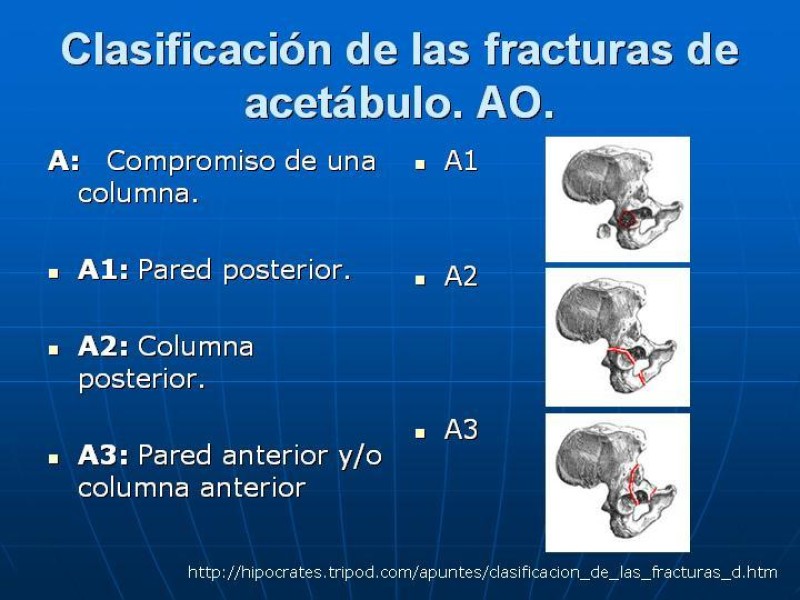 Diapositiva 21 de Fractura de Pelvis