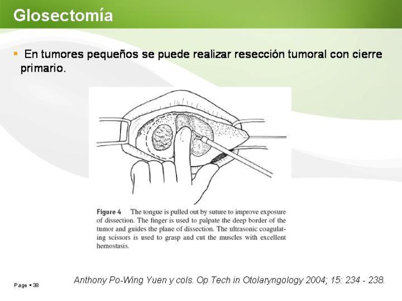 Diapositiva 37 de Cáncer de Lengua