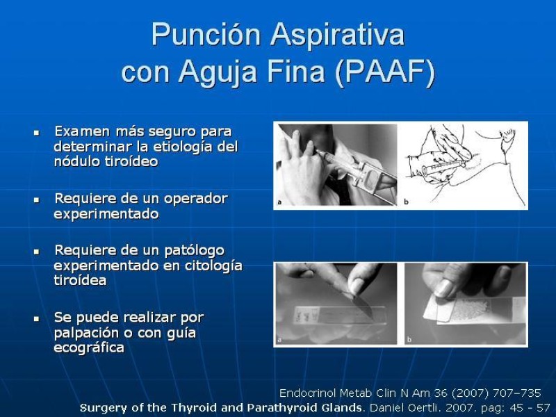Diapositiva 13 de Estudio del Nódulo Tiroídeo