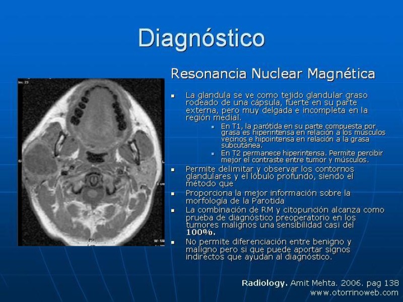 Diapositiva 14 de Tumores de las Glándulas Parótidas
