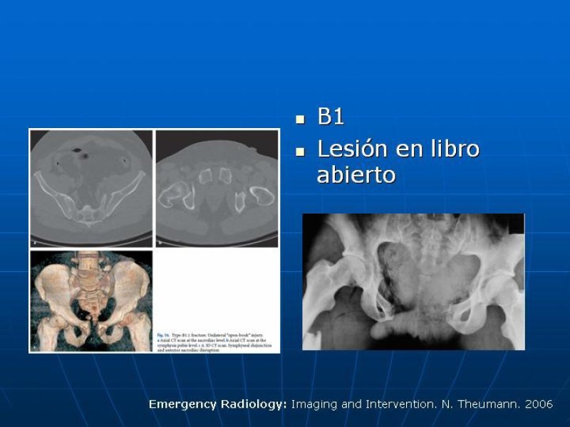 Diapositiva 14 de Fractura de Pelvis