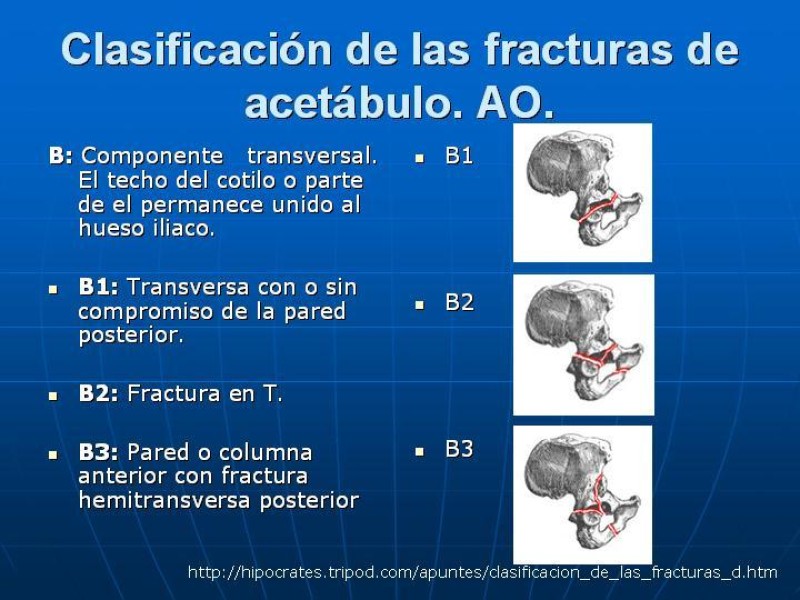 Diapositiva 22 de Fractura de Pelvis