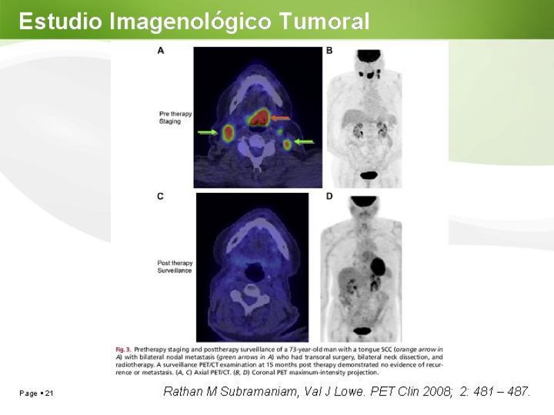 Diapositiva 20 de Cáncer de Lengua