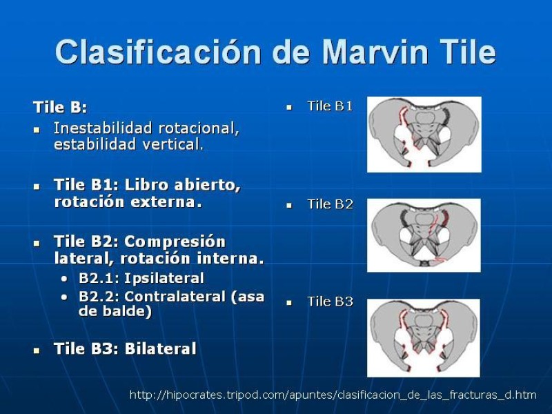 Diapositiva 19 de Fractura de Pelvis