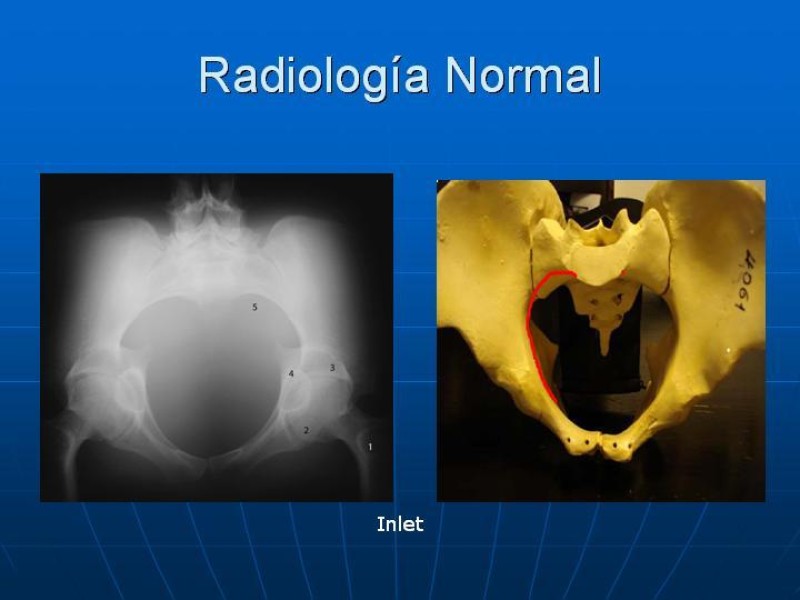 Diapositiva 12 de Fractura de Pelvis