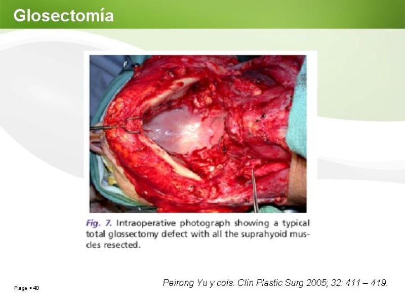 Diapositiva 39 de Cáncer de Lengua