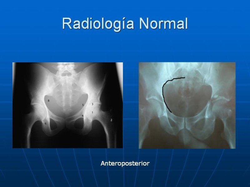Diapositiva 10 de Fractura de Pelvis