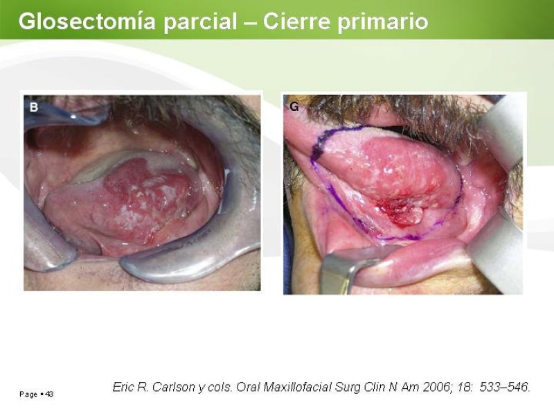Diapositiva 42 de Cáncer de Lengua