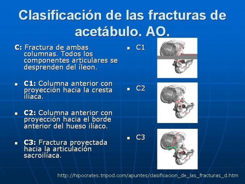 Diapositiva 23 de Fractura de Pelvis
