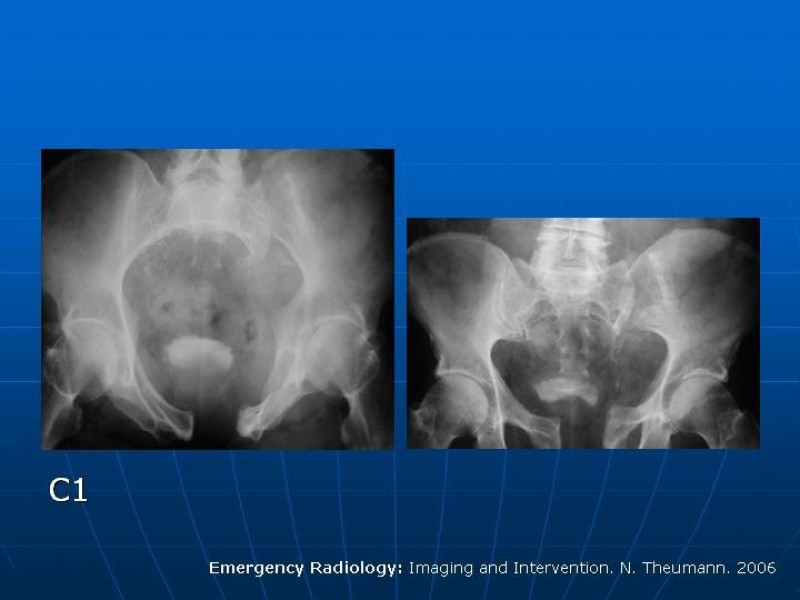 Diapositiva 16 de Fractura de Pelvis