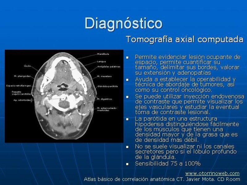 Diapositiva 13 de Tumores de las Glándulas Parótidas