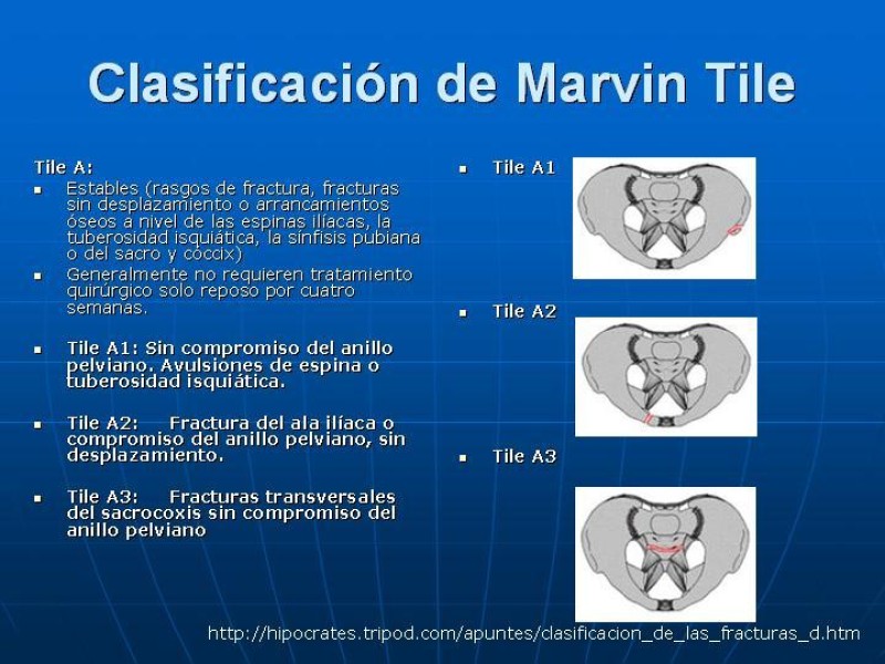 Diapositiva 18 de Fractura de Pelvis