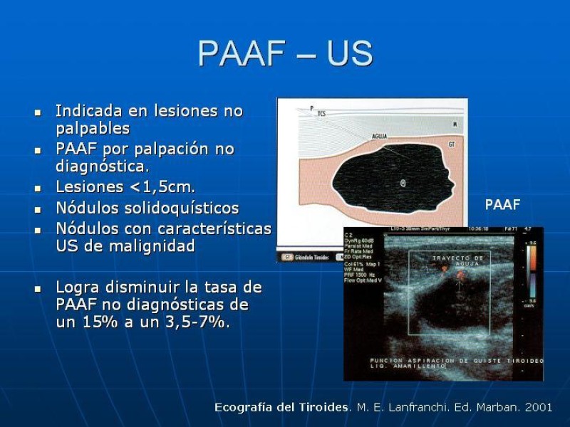 Diapositiva 14 de Estudio del Nódulo Tiroídeo