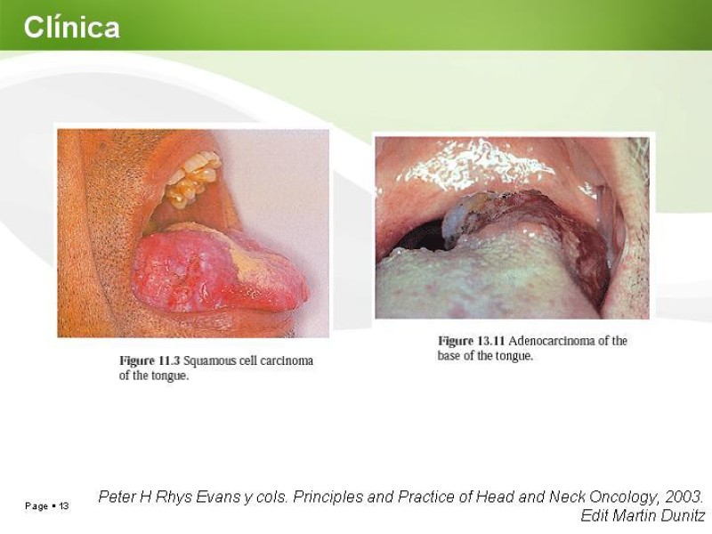 Diapositiva 12 de Cáncer de Lengua