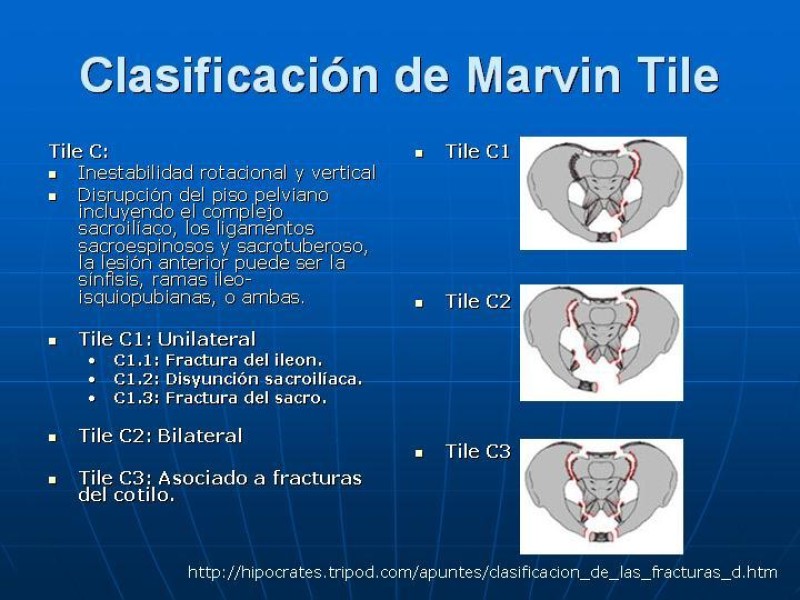 Diapositiva 20 de Fractura de Pelvis