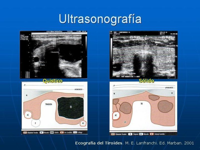 Diapositiva 9 de Estudio del Nódulo Tiroídeo