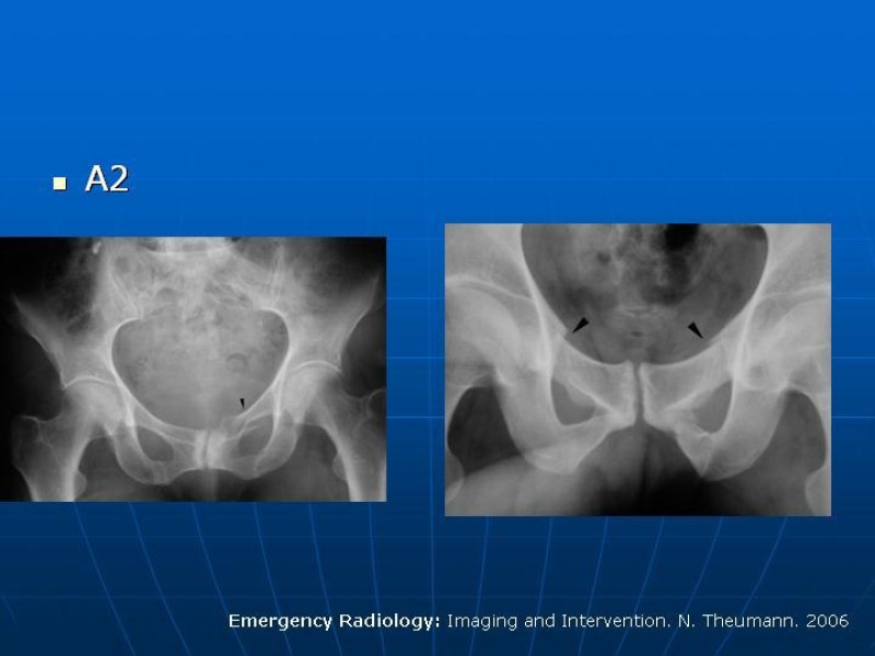 Diapositiva 13 de Fractura de Pelvis
