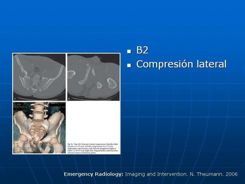 Diapositiva 15 de Fractura de Pelvis