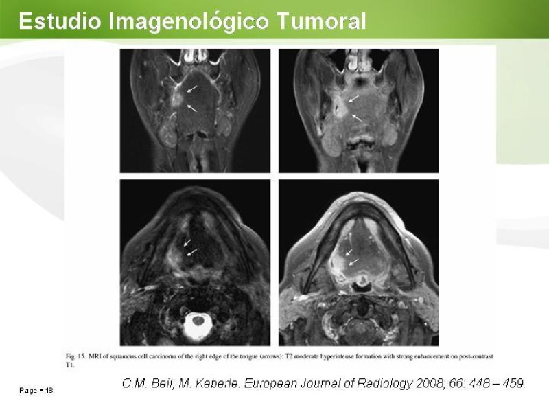 Diapositiva 17 de Cáncer de Lengua