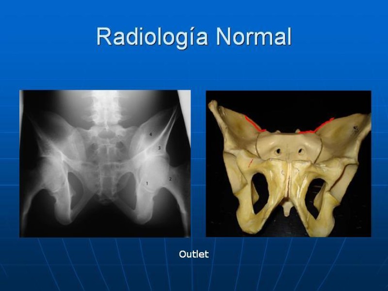 Diapositiva 11 de Fractura de Pelvis
