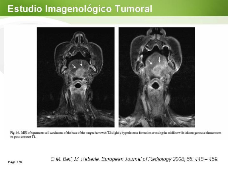 Diapositiva 18 de Cáncer de Lengua