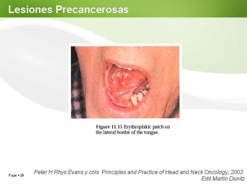 Diapositiva 28 de Cáncer de Lengua