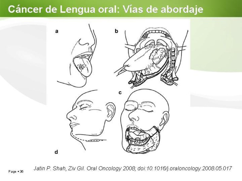 Diapositiva 35 de Cáncer de Lengua