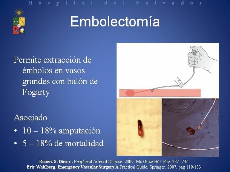 Diapositiva 23 de Isquemia arterial aguda en EEII