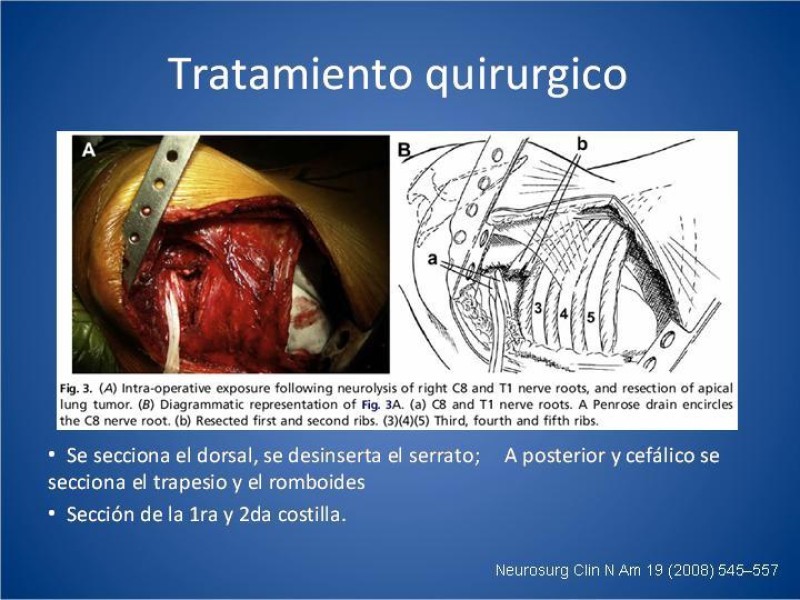 Diapositiva 19 de Tumor de Pancoast