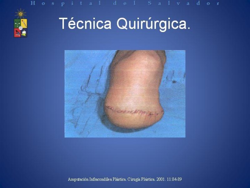 Diapositiva 15 de Amputación Infracondilea.