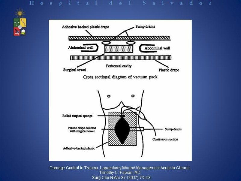 Diapositiva 19 de Vacuum-Assisted Closure en laparotomía. 