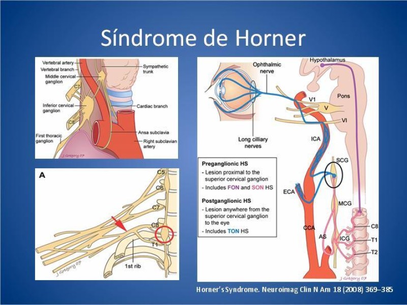Diapositiva 6 de Tumor de Pancoast