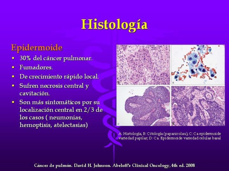 Diapositiva 21 de Cáncer de pulmón