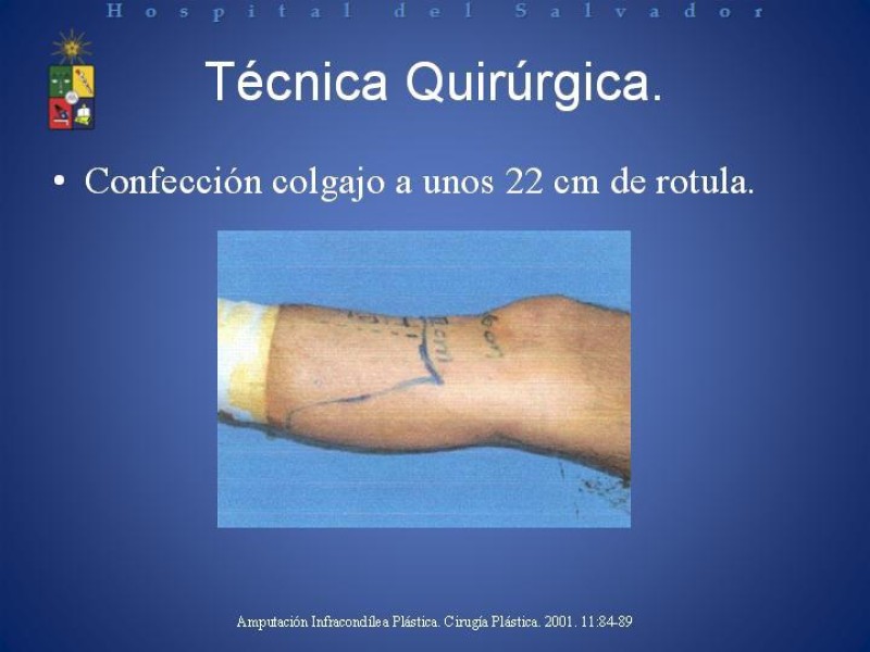 Diapositiva 9 de Amputación Infracondilea.