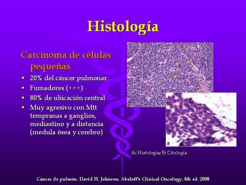 Diapositiva 23 de Cáncer de pulmón