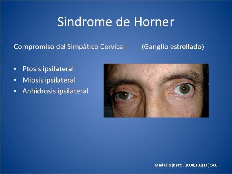 Diapositiva 5 de Tumor de Pancoast