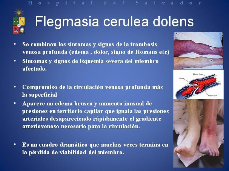 Diapositiva 13 de Isquemia arterial aguda en EEII