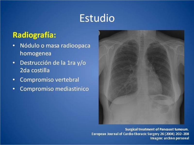 Diapositiva 8 de Tumor de Pancoast