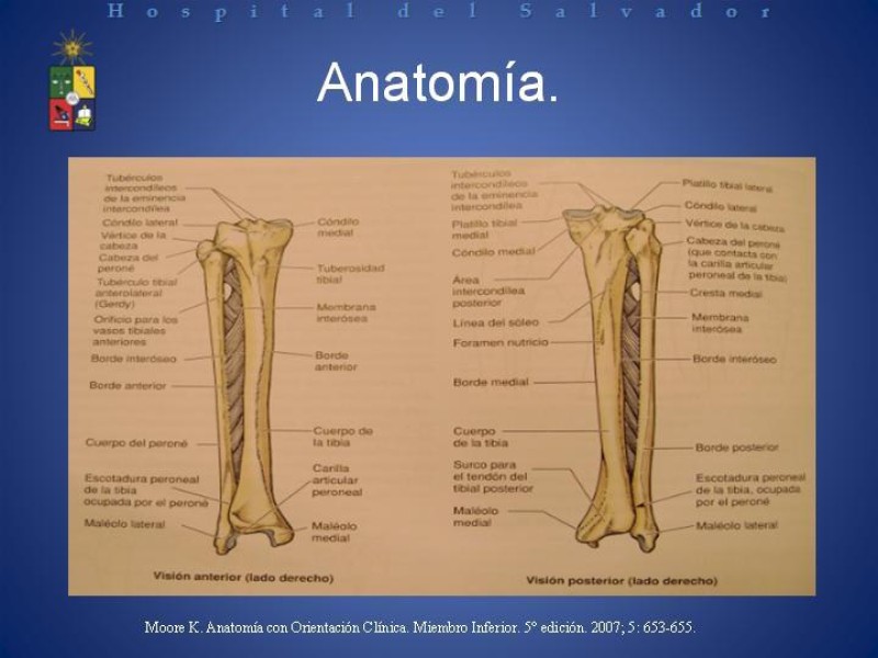 Diapositiva 3 de Amputación Infracondilea.