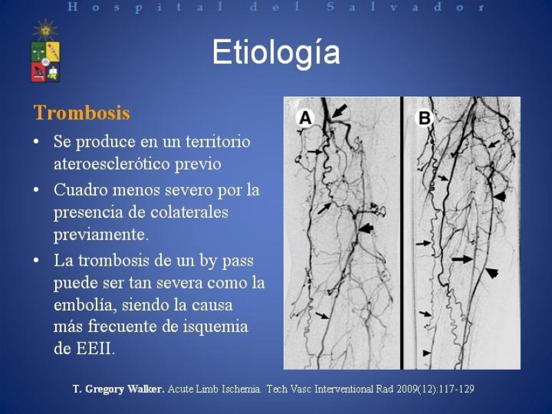 Diapositiva 2 de Isquemia arterial aguda en EEII