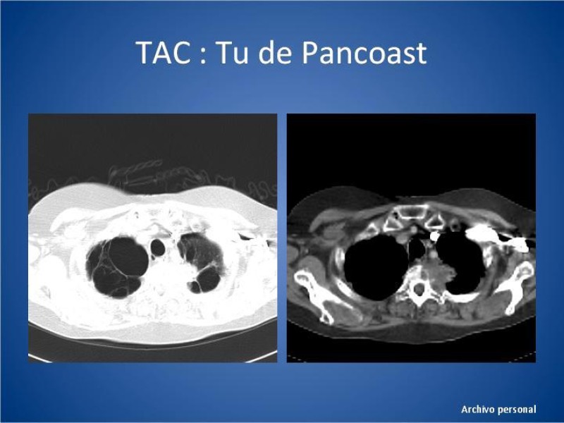 Diapositiva 10 de Tumor de Pancoast