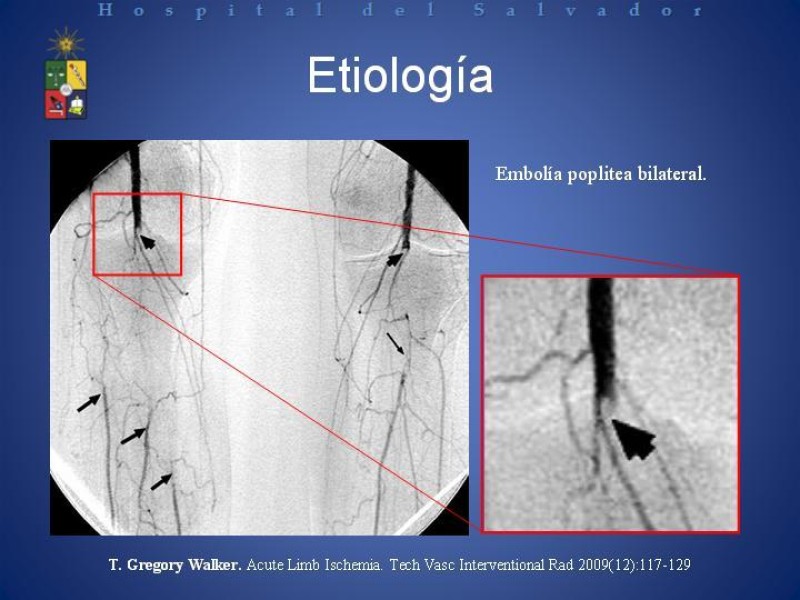 Diapositiva 5 de Isquemia arterial aguda en EEII