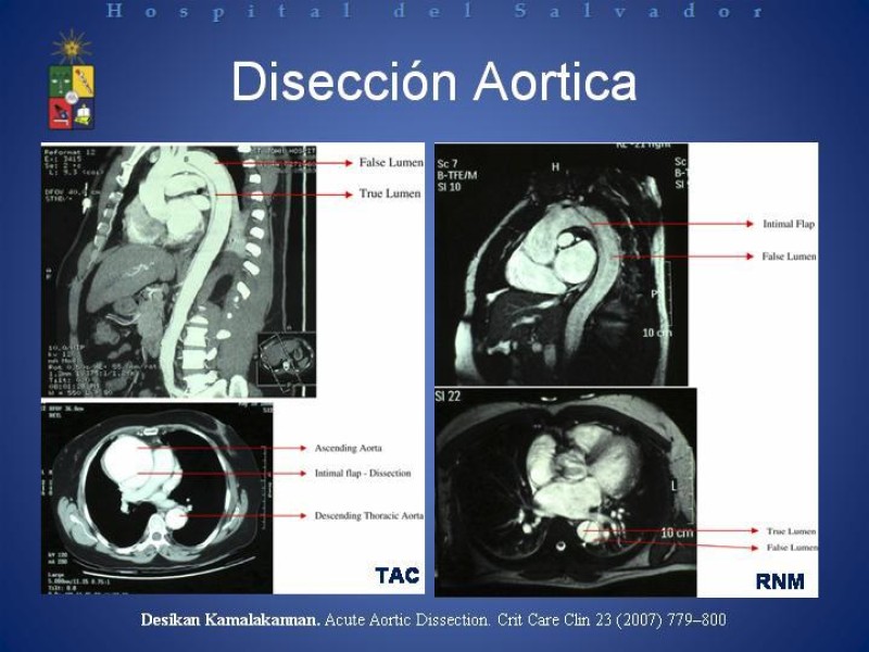 Diapositiva 9 de Tratamiento de la Disección Aortica