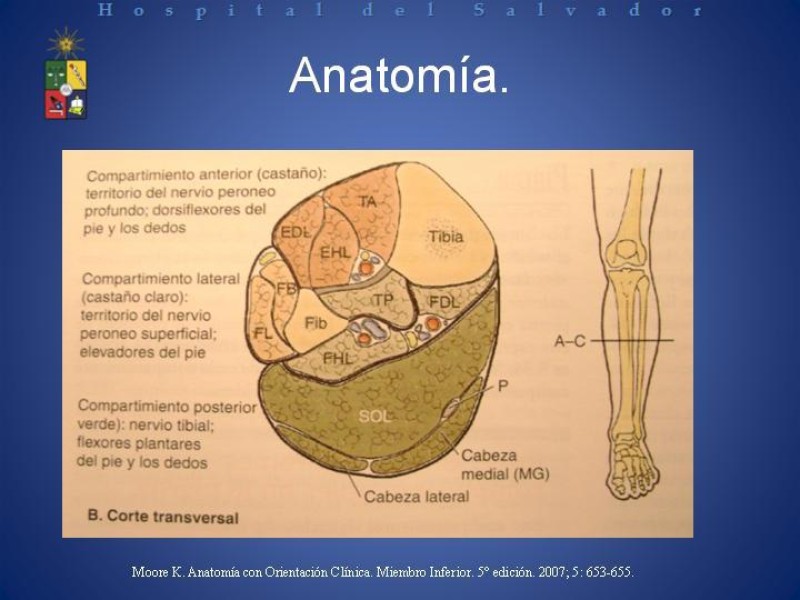 Diapositiva 6 de Amputación Infracondilea.