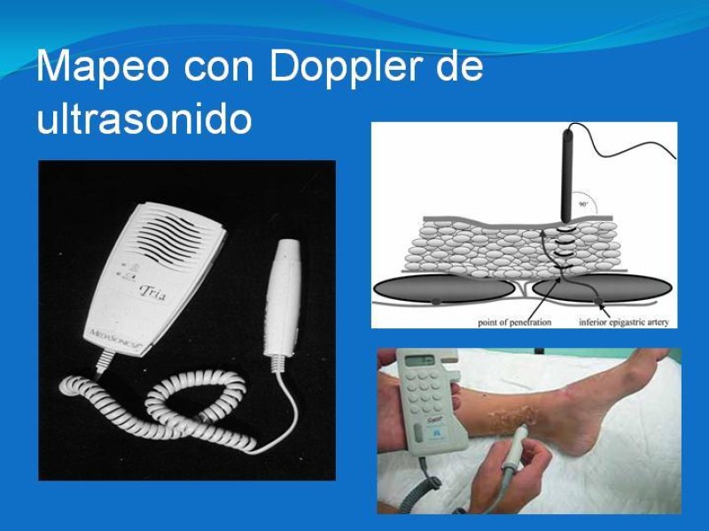 Diapositiva 13 de Colgajos estilo libre: Aplicación en cirugía reparadora