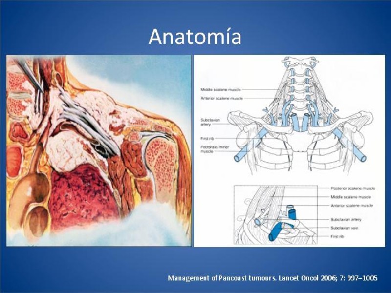 Diapositiva 3 de Tumor de Pancoast