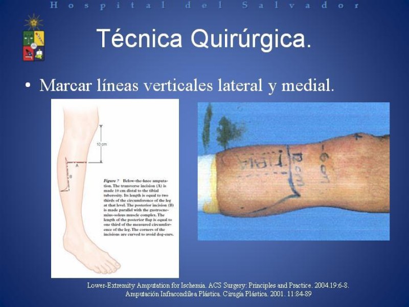 Diapositiva 8 de Amputación Infracondilea.