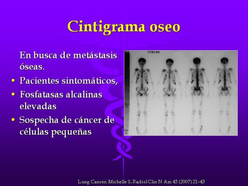 Diapositiva 33 de Cáncer de pulmón