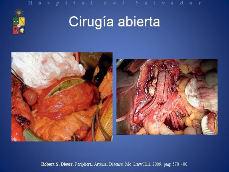 Diapositiva 21 de Tratamiento de la Disección Aortica