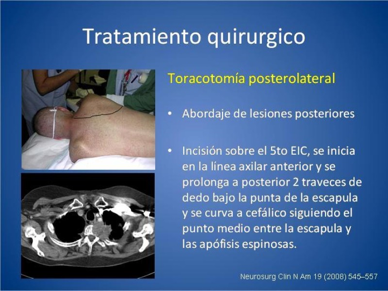 Diapositiva 18 de Tumor de Pancoast